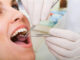 Diseases of the teeth