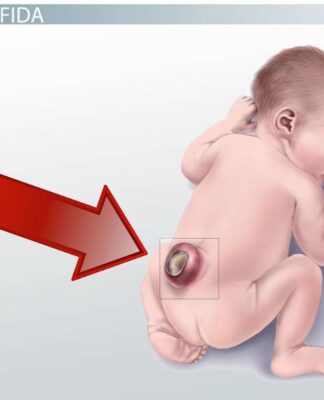 What is spina bifida and what are its symptoms