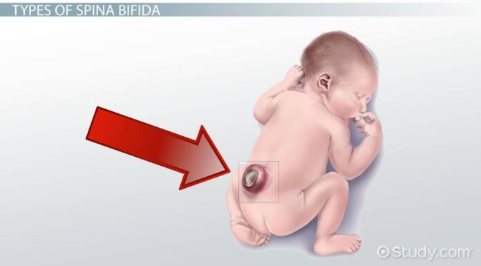 What is spina bifida and what are its symptoms