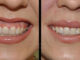 Stop Living With a Gummy Smile by getting this non-surgical treatment!