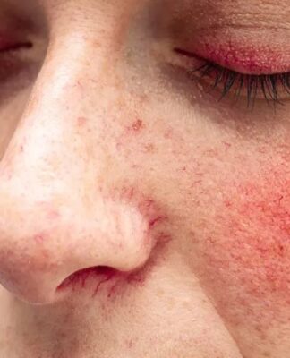 Rosacea Signs Causes and Treatment