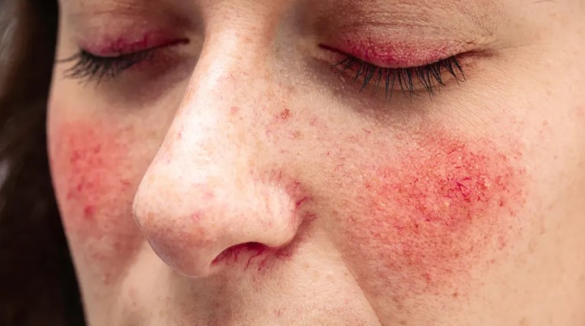 Rosacea Signs Causes and Treatment